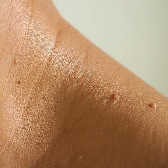 Close-up of textured skin with small bumps.