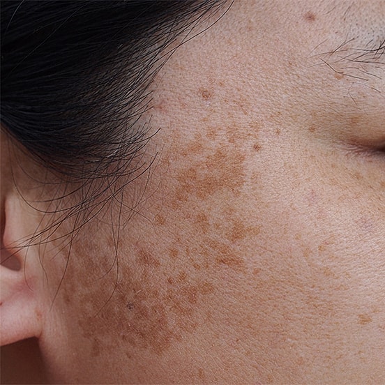 Skin close-up with pigmentation irregularities.
