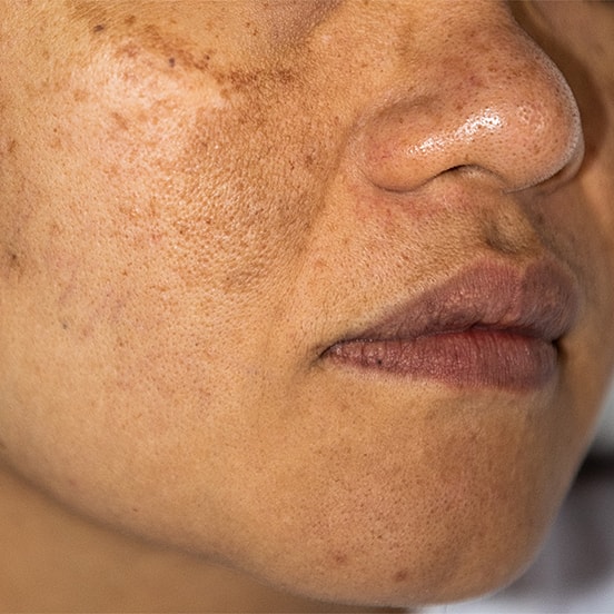 Close-up of textured skin on a person's face.
