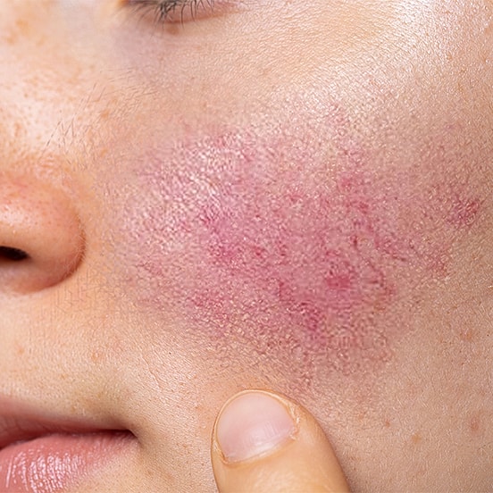 Skin with redness and irritation on cheek.