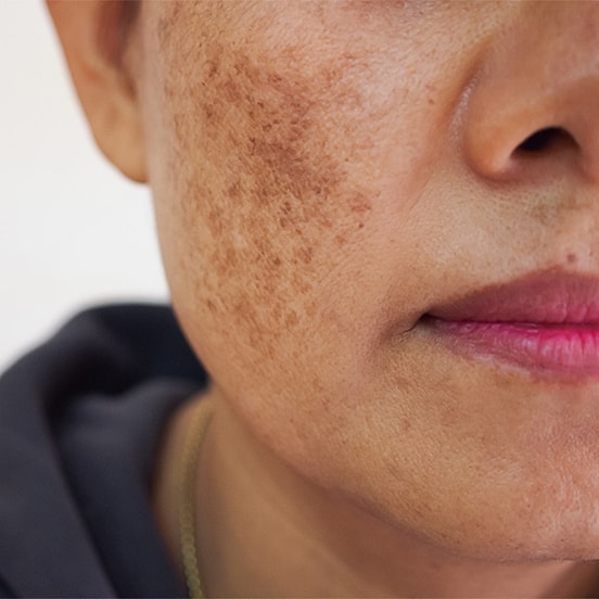 Close-up of skin with freckles and natural makeup.