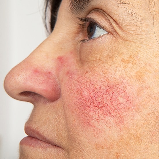 Close-up of face with skin redness and irritation.