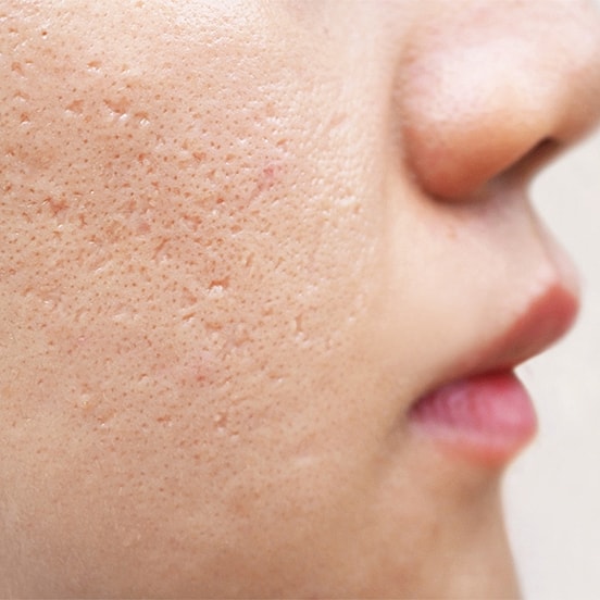 Close-up of textured skin on face.