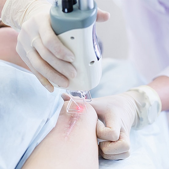 Laser treatment on a patient's surgical scar.
