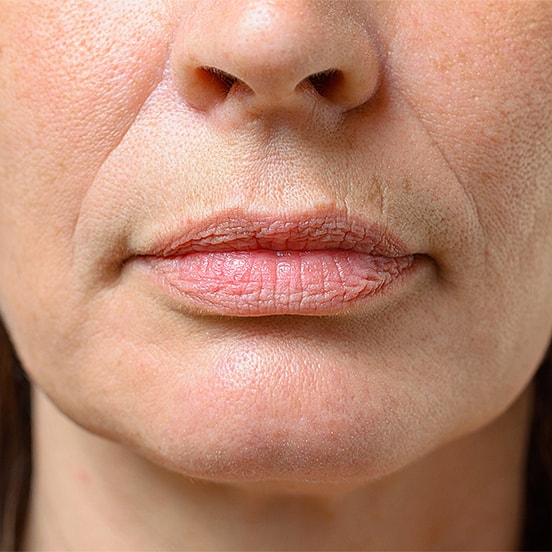 Dry, cracked lips and textured skin close-up.