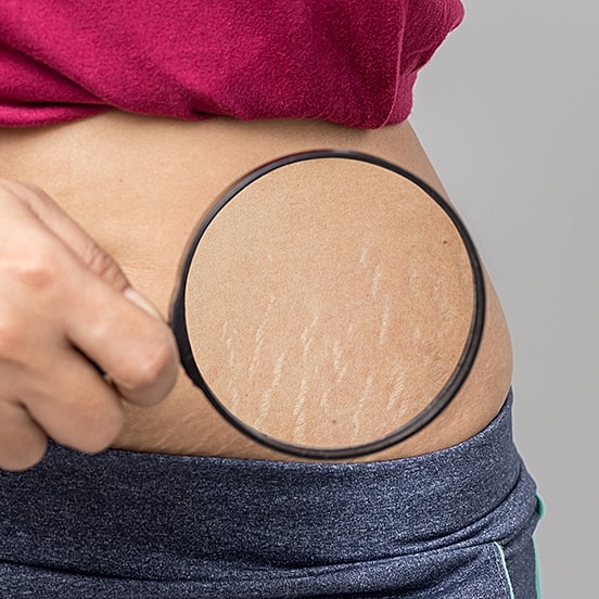 Magnifying glass highlighting skin stretch marks.