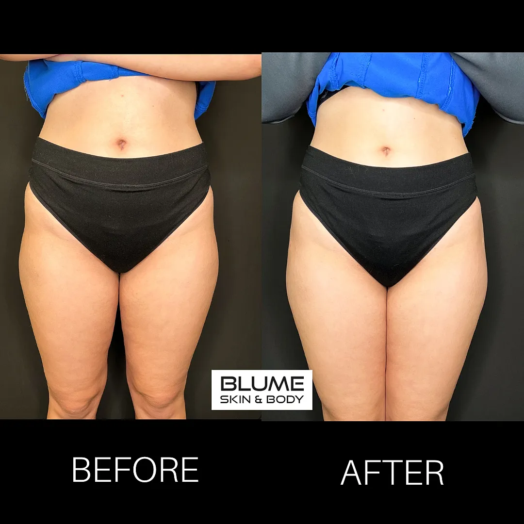 Before and after body transformation comparison image.