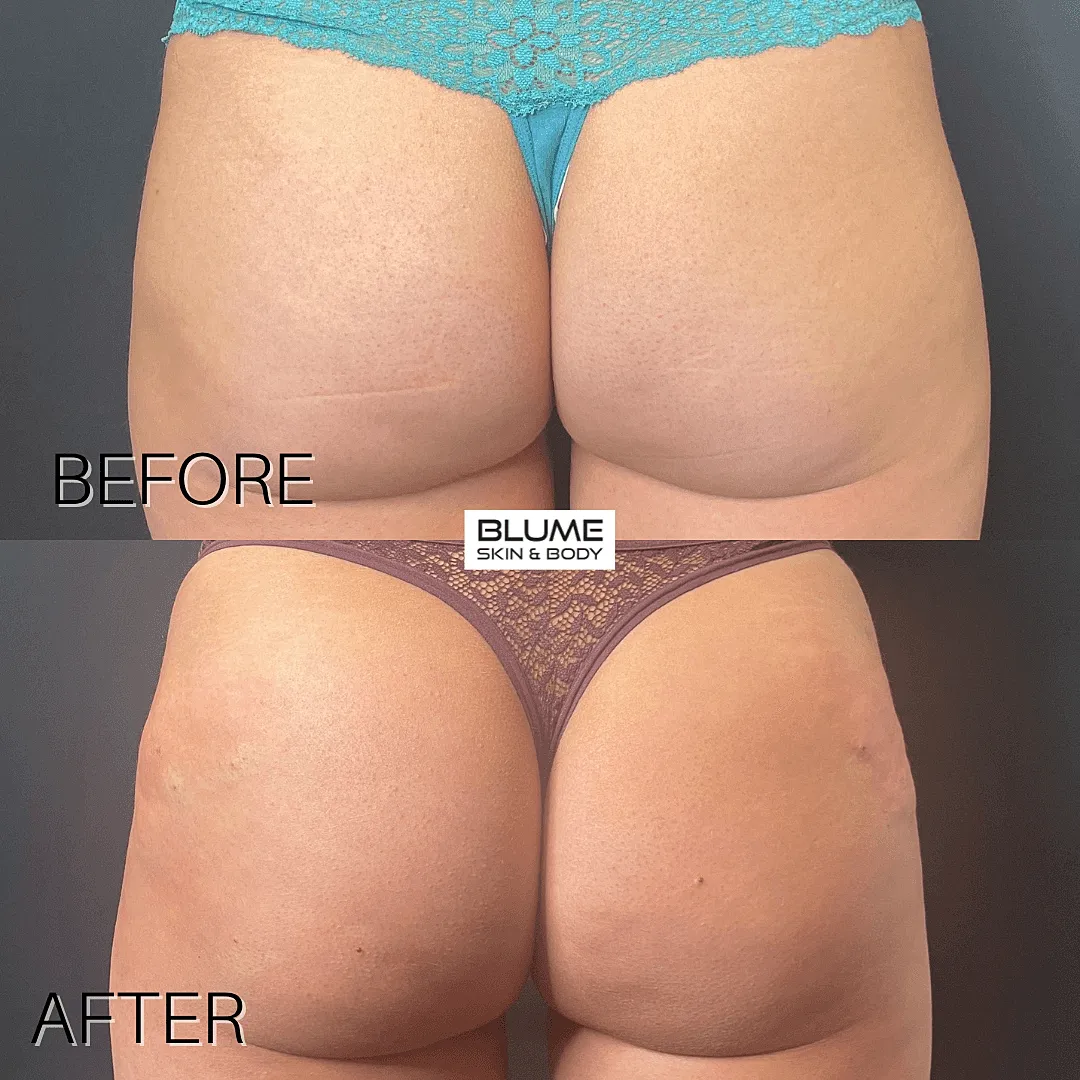 Before and after body skin treatment results.