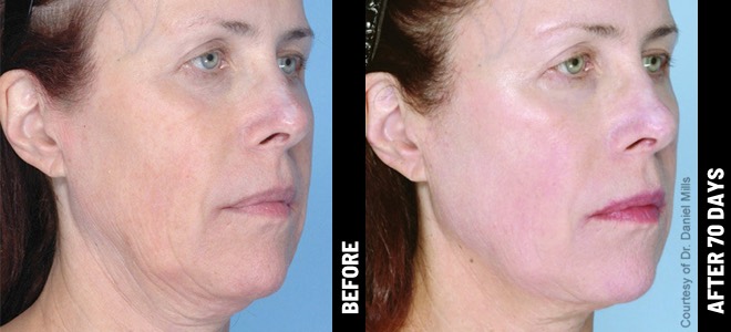 Ultherapy Full Face Treatment Before and after