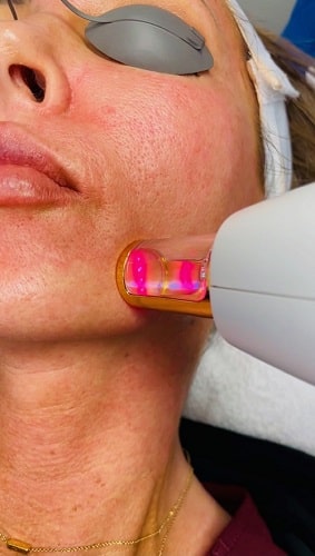 Resurfx Laser Treatment
