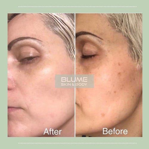 Photofacial Befoe and After Results