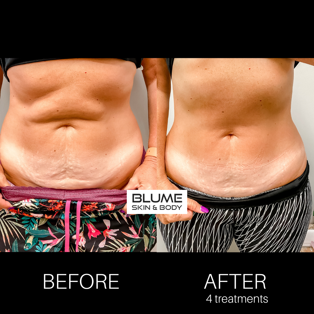 blumesculpt pt 2 before and after