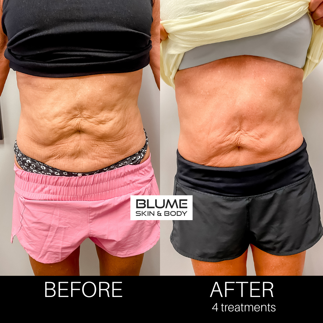 blumesculpt pt. 1 before and after