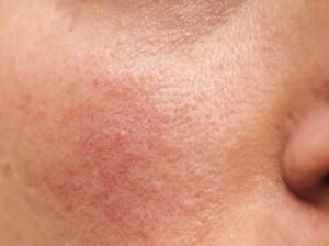 rosacea example close up