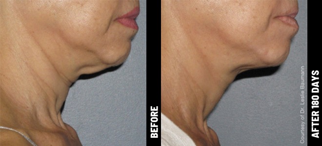 ultherapy before and after neck