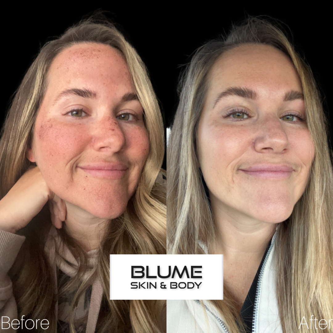 Patient 1946 Before After Photos Scottsdale AZ